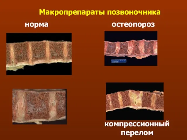 Макропрепараты позвоночника норма остеопороз компрессионный перелом