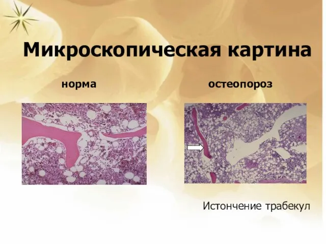 Микроскопическая картина Микроскопическая картина норма остеопороз Истончение трабекул