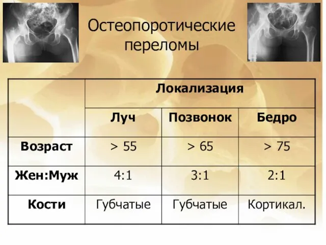 Остеопоротические переломы