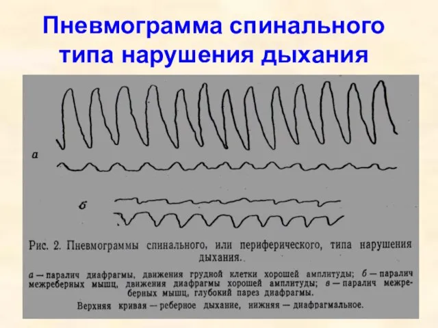 Пневмограмма спинального типа нарушения дыхания