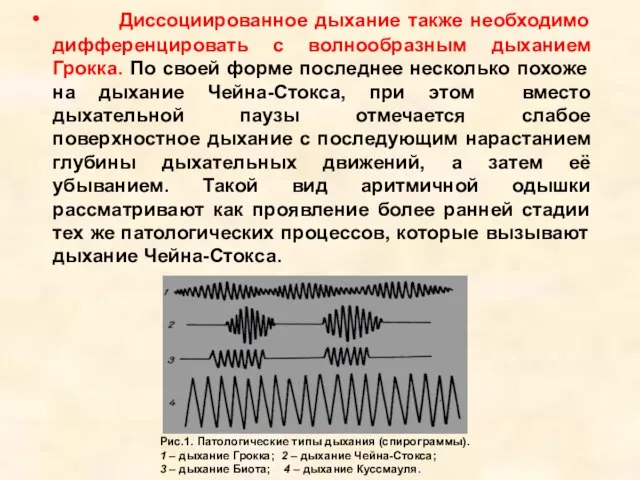 Диссоциированное дыхание также необходимо дифференцировать с волнообразным дыханием Грокка. По своей форме