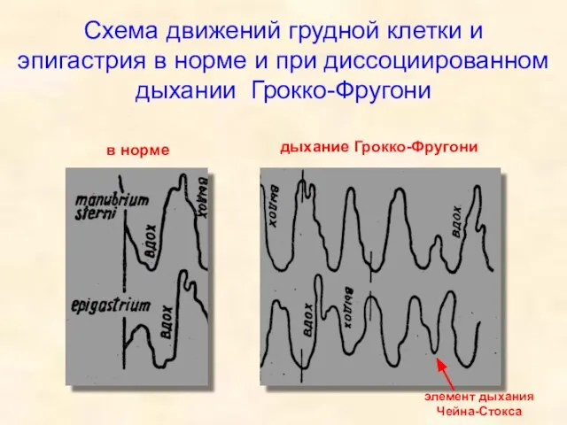 Схема движений грудной клетки и эпигастрия в норме и при диссоциированном дыхании