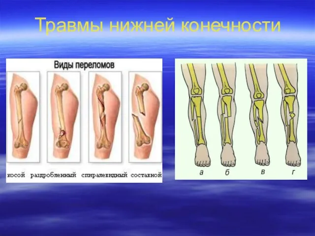 Травмы нижней конечности