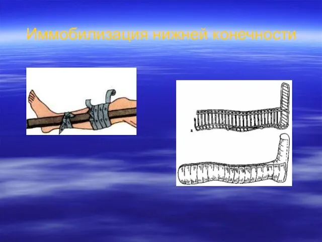 Иммобилизация нижней конечности