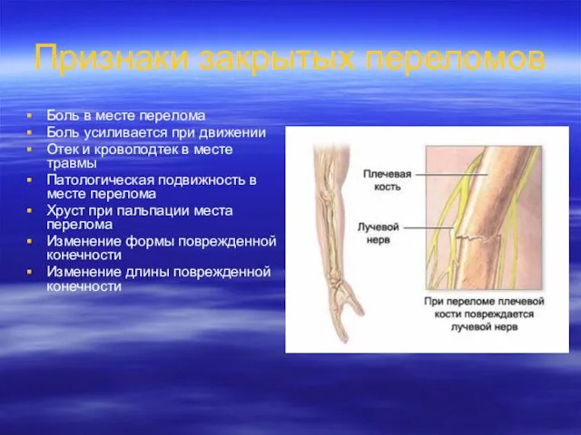 Признаки закрытых переломов Боль в месте перелома Боль усиливается при движении Отек