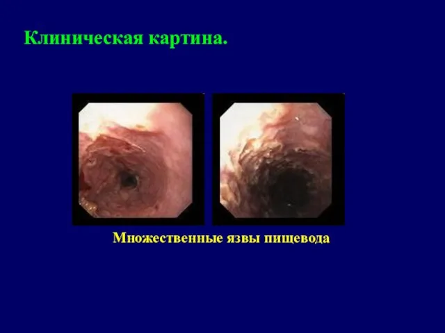 Клиническая картина. Множественные язвы пищевода