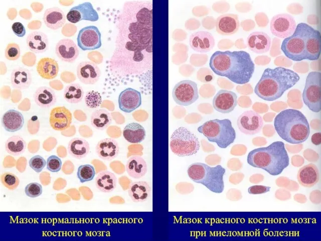 Мазок нормального красного костного мозга Мазок красного костного мозга при миеломной болезни