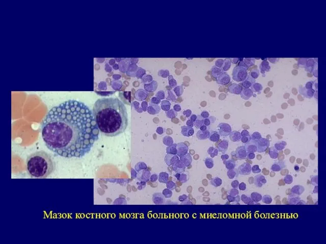 Мазок костного мозга больного с миеломной болезнью