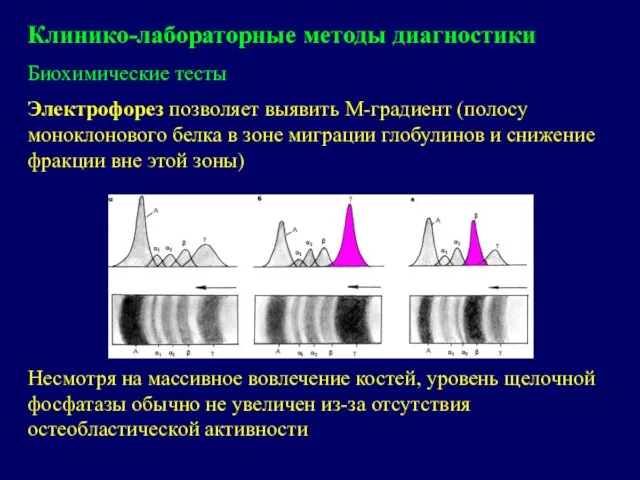 Клинико-лабораторные методы диагностики Биохимические тесты Электрофорез позволяет выявить М-градиент (полосу моноклонового белка