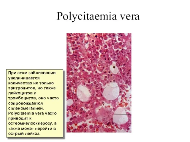 Polycitaemia vera При этом заболевании увеличивается количество не только эритроцитов, но также