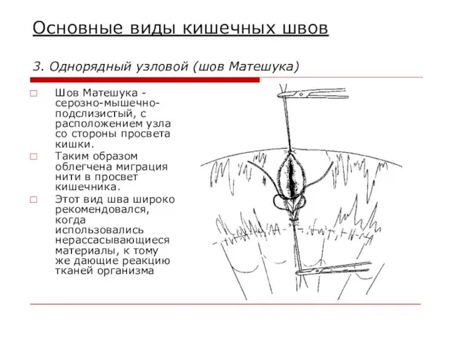 Основные виды кишечных швов 3. Однорядный узловой (шов Матешука) Шов Матешука -