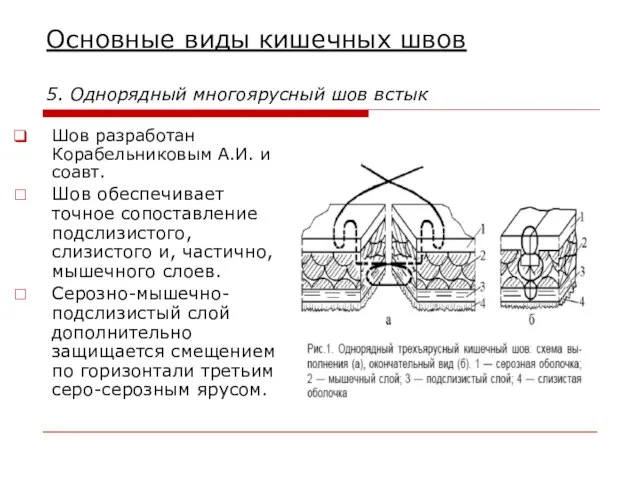 Основные виды кишечных швов 5. Однорядный многоярусный шов встык Шов разработан Корабельниковым