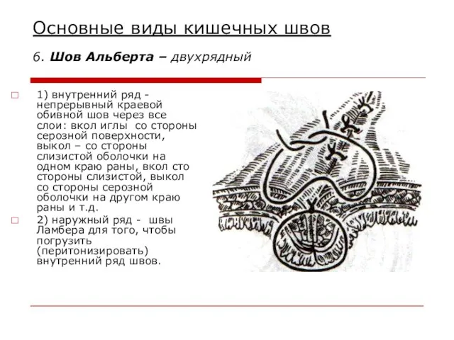 Основные виды кишечных швов 6. Шов Альберта – двухрядный 1) внутренний ряд