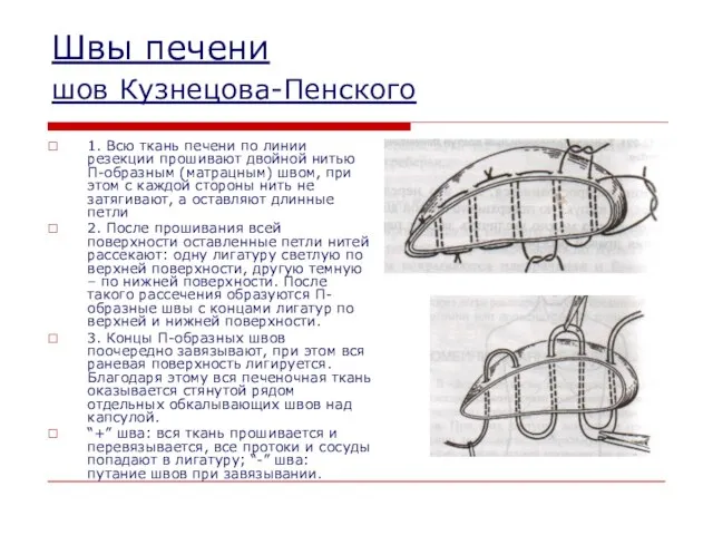 Швы печени шов Кузнецова-Пенского 1. Всю ткань печени по линии резекции прошивают