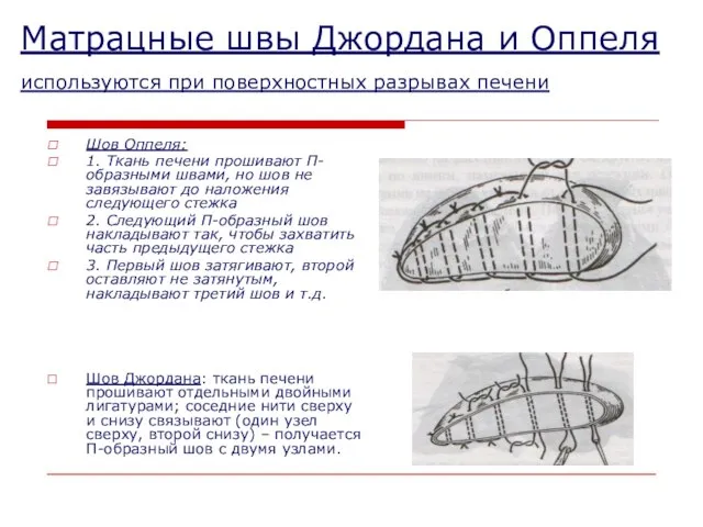 Матрацные швы Джордана и Оппеля используются при поверхностных разрывах печени Шов Оппеля: