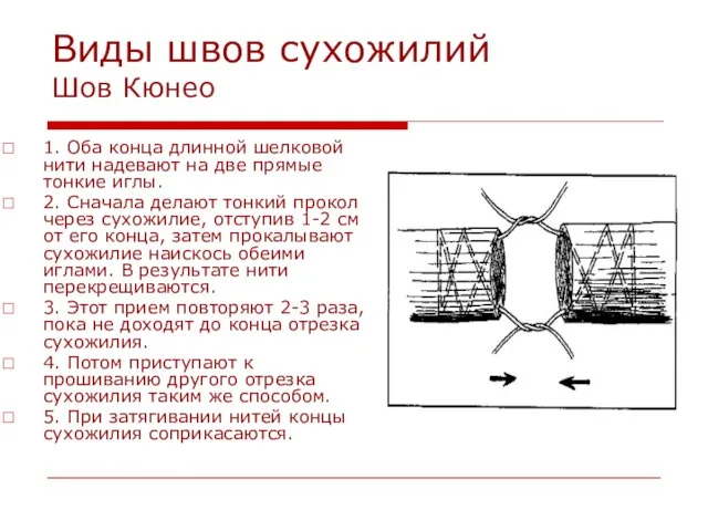 Виды швов сухожилий Шов Кюнео 1. Оба конца длинной шелковой нити надевают