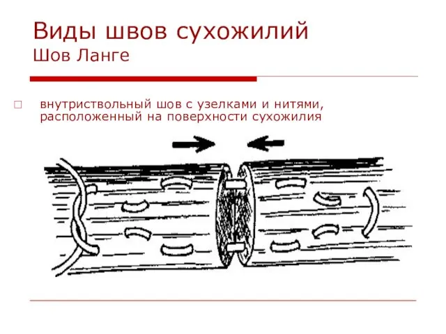 Виды швов сухожилий Шов Ланге внутриствольный шов с узелками и нитями, расположенный на поверхности сухожилия