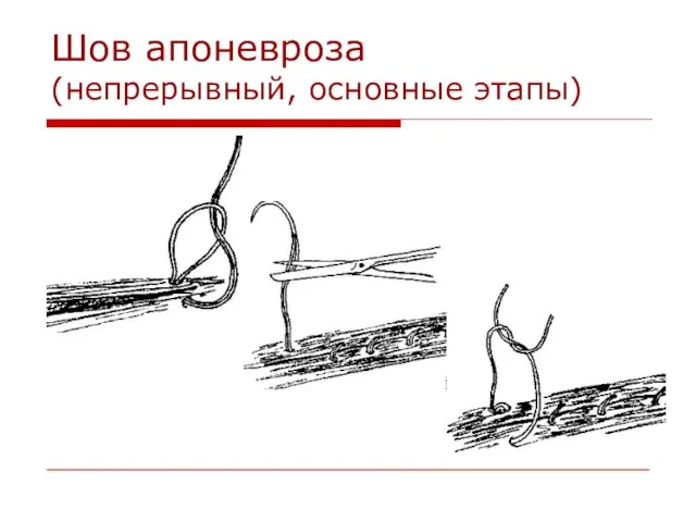 Шов апоневроза (непрерывный, основные этапы)