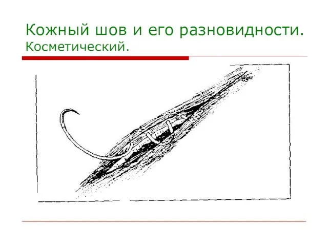 Кожный шов и его разновидности. Косметический.