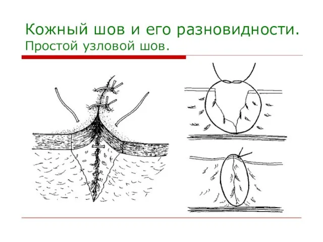 Кожный шов и его разновидности. Простой узловой шов.