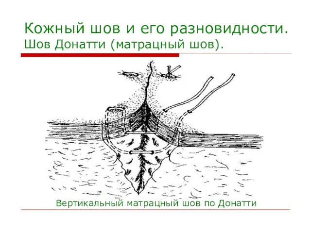 Кожный шов и его разновидности. Шов Донатти (матрацный шов). Вертикальный матрацный шов по Донатти