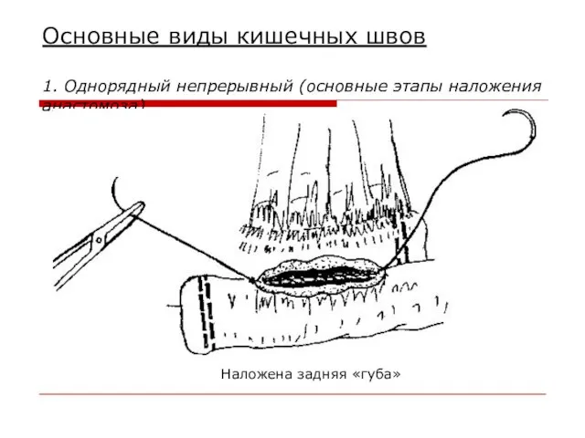 Основные виды кишечных швов 1. Однорядный непрерывный (основные этапы наложения анастомоза) Наложена задняя «губа»