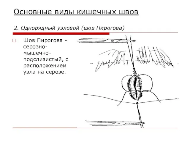 Основные виды кишечных швов 2. Однорядный узловой (шов Пирогова) Шов Пирогова -