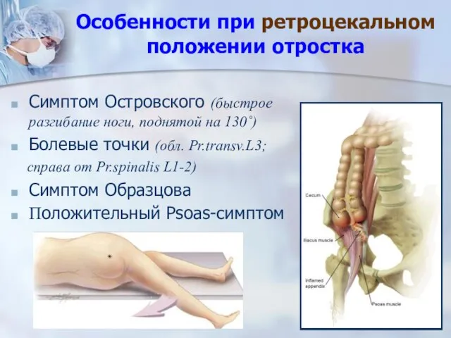 Особенности при ретроцекальном положении отростка Симптом Островского (быстрое разгибание ноги, поднятой на