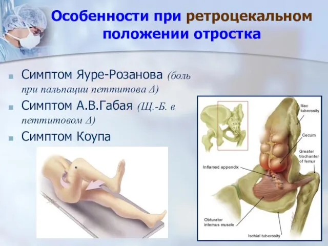 Особенности при ретроцекальном положении отростка Симптом Яуре-Розанова (боль при пальпации петтитова Δ)