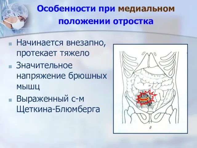 Особенности при медиальном положении отростка Начинается внезапно, протекает тяжело Значительное напряжение брюшных мышц Выраженный с-м Щеткина-Блюмберга