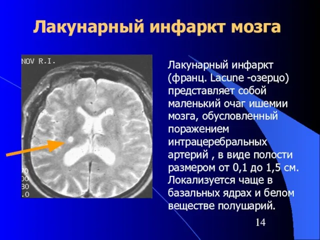 Лакунарный инфаркт мозга Лакунарный инфаркт (франц. Lacune -озерцо) представляет собой маленький очаг