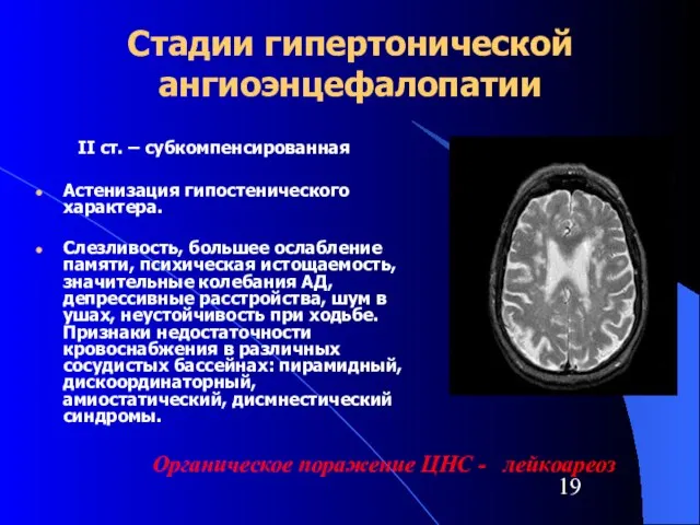 Стадии гипертонической ангиоэнцефалопатии II ст. – субкомпенсированная Астенизация гипостенического характера. Слезливость, большее