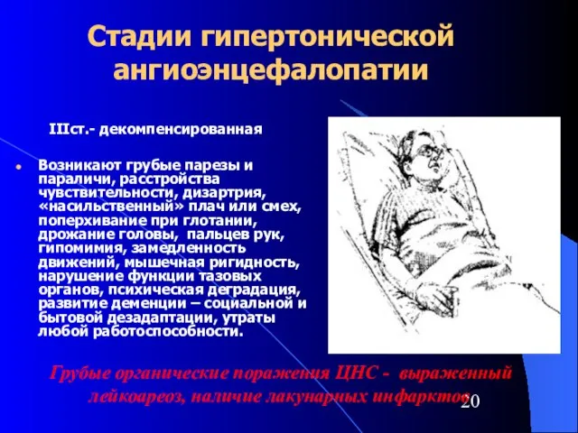 Стадии гипертонической ангиоэнцефалопатии IIIст.- декомпенсированная Возникают грубые парезы и параличи, расстройства чувствительности,