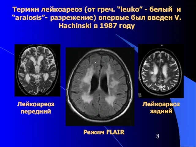 Лейкоареоз передний Лейкоареоз задний Режим FLAIR Термин лейкоареоз (от греч. “leuko” -