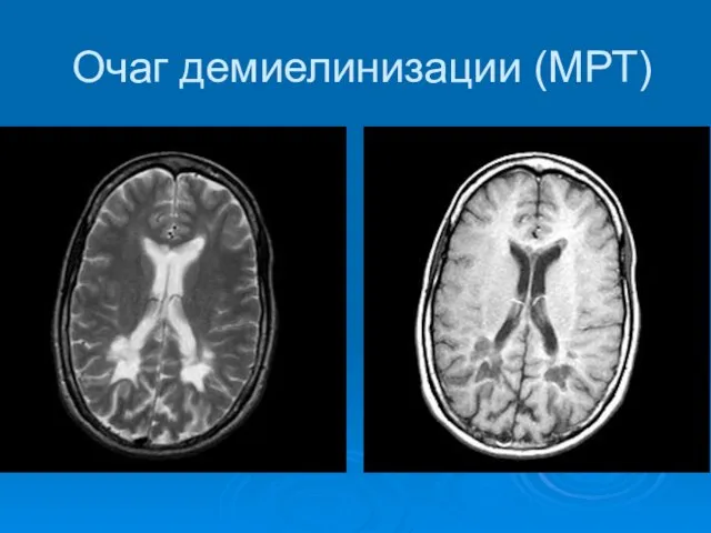 Очаг демиелинизации (МРТ)