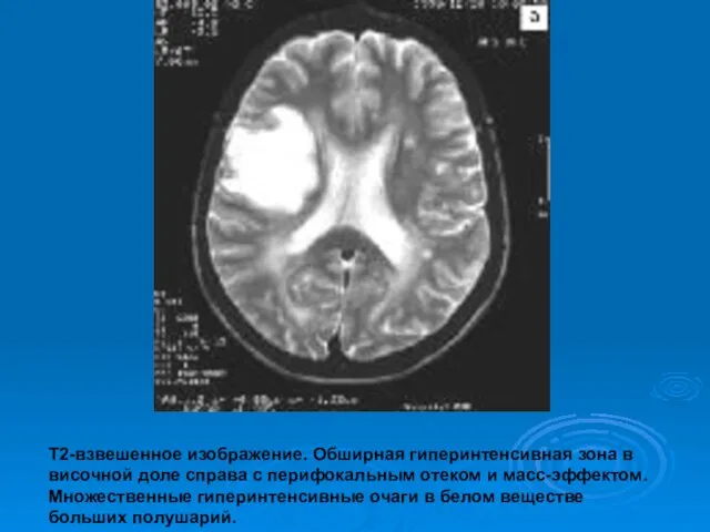 Т2-взвешенное изображение. Обширная гиперинтенсивная зона в височной доле справа с перифокальным отеком