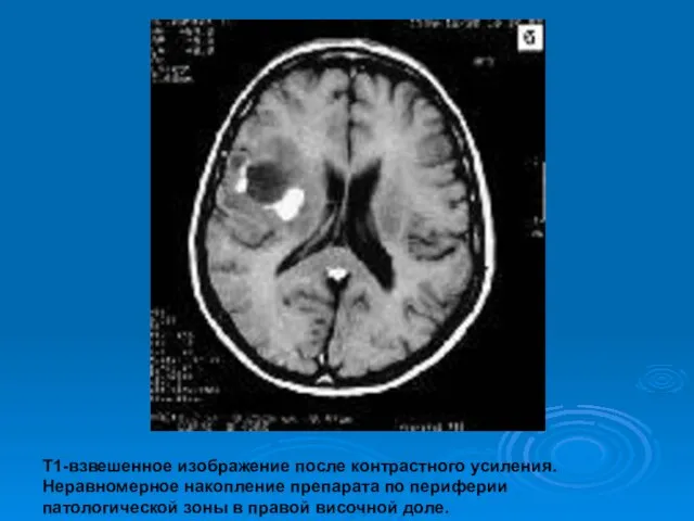 Т1-взвешенное изображение после контрастного усиления. Неравномерное накопление препарата по периферии патологической зоны в правой височной доле.