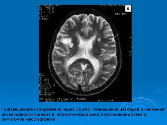 Т2-взвешенное изображение через 3,5 мес. Уменьшение размеров и снижение интенсивности сигнала в