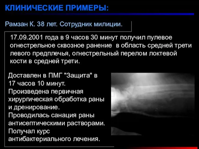 Рамзан К. 38 лет. Cотрудник милиции. КЛИНИЧЕСКИЕ ПРИМЕРЫ: 17.09.2001 года в 9