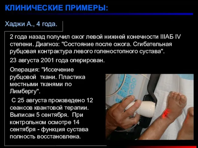 Хаджи А., 4 года. КЛИНИЧЕСКИЕ ПРИМЕРЫ: 2 года назад получил ожог левой