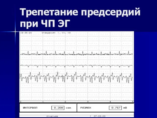 Трепетание предсердий при ЧП ЭГ