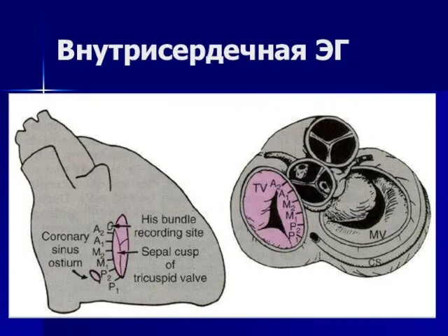 Внутрисердечная ЭГ