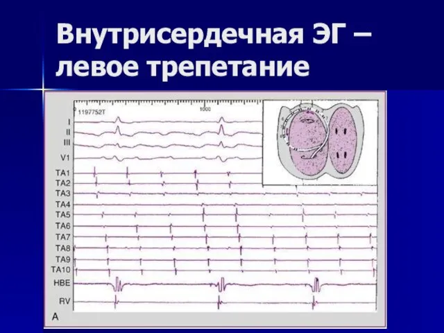 Внутрисердечная ЭГ – левое трепетание