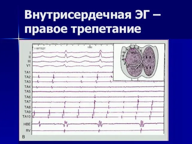 Внутрисердечная ЭГ – правое трепетание