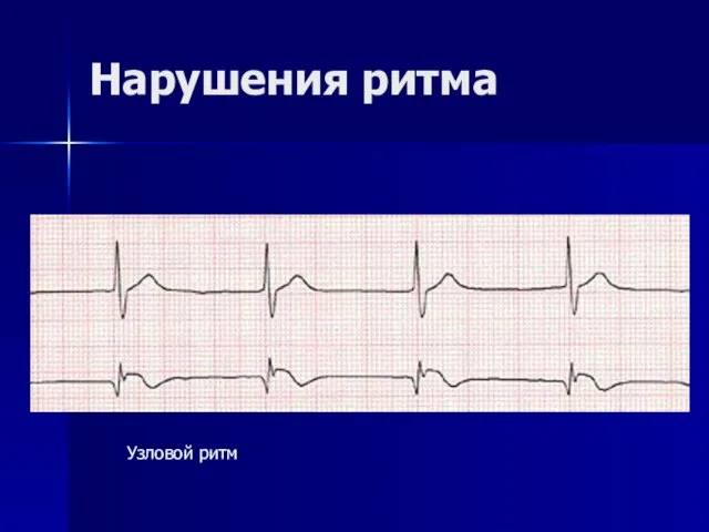 Нарушения ритма Узловой ритм