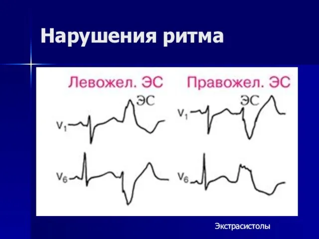 Нарушения ритма Экстрасистолы