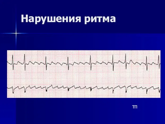 Нарушения ритма ТП