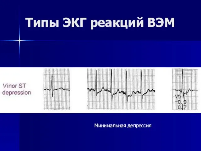 Типы ЭКГ реакций ВЭМ Минимальная депрессия