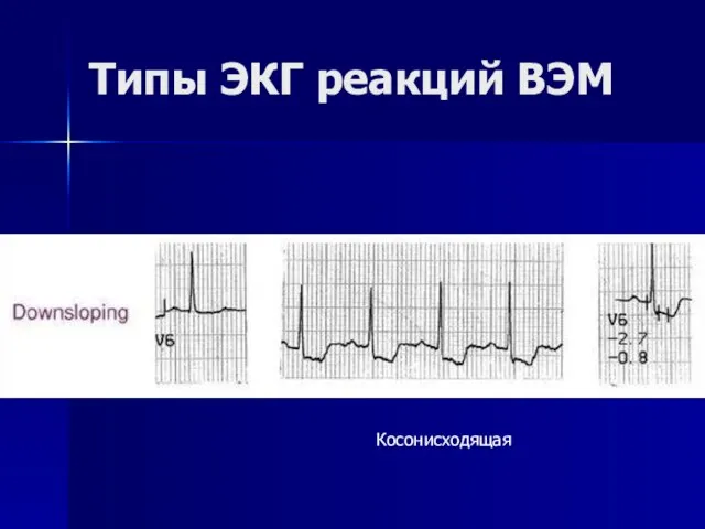 Типы ЭКГ реакций ВЭМ Косонисходящая