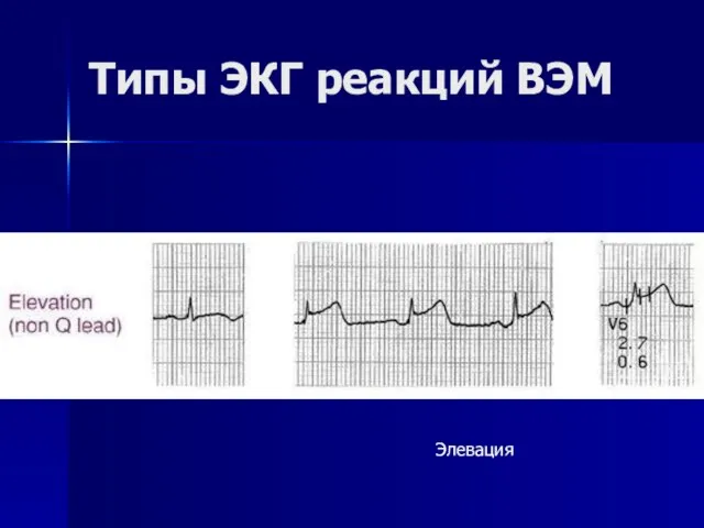 Типы ЭКГ реакций ВЭМ Элевация